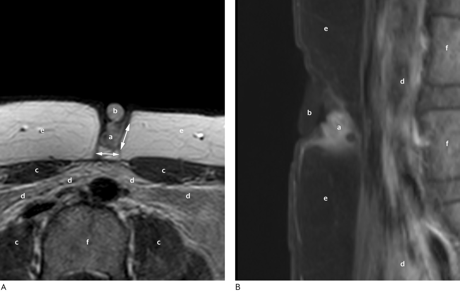Figur 2 MR-bildene viser en lesjon som ligger overfladisk for rectusmuskulaturen og i dypet for umbilicus i subkutant&hellip;