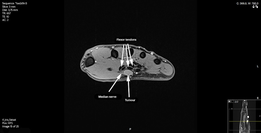Figure 3 MRI of hand, T1 weighted, transverse plane, fat-suppressed. Note the tumour's close proximity to the median nerve&hellip;