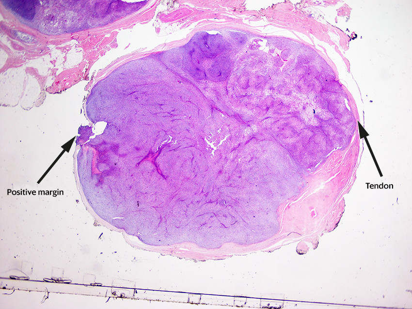 Figure 4 Haematoxylin and eosin stained tumour slice at 10x magnification. The slice clearly shows that the tumour is solid&hellip;