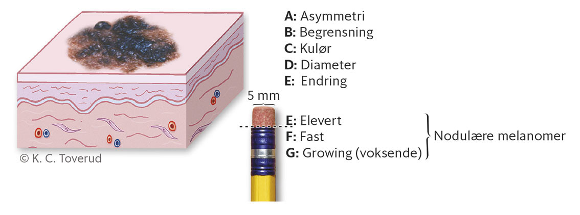Figur 1 ABCDE/EFG-regelen.
