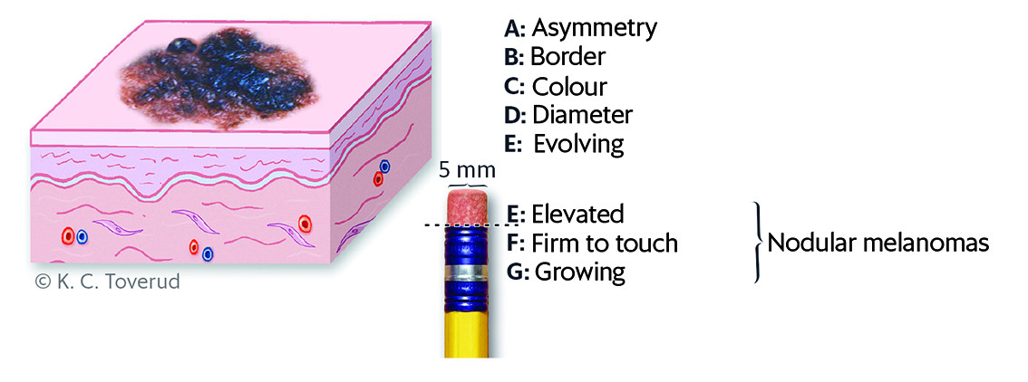 Figure 1 The ABCDE/EFG rule.