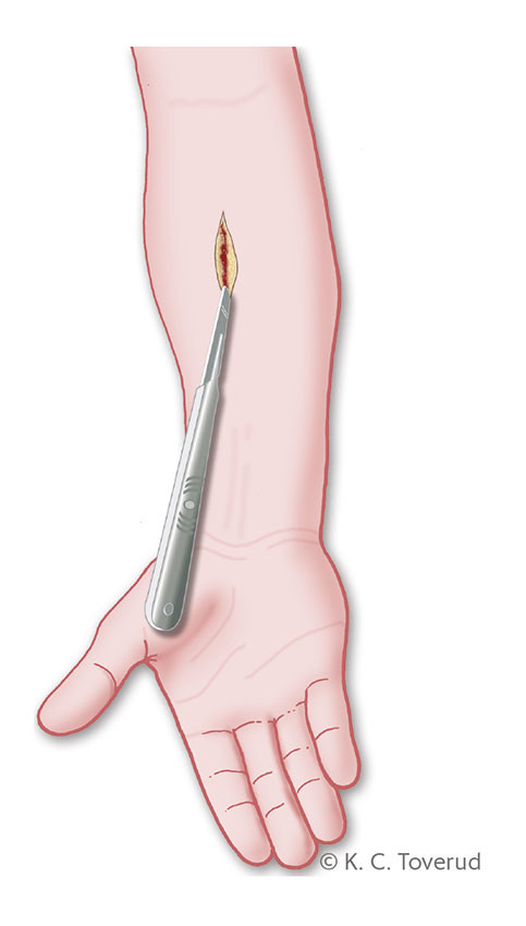Figure 2 The incision should run in a vertical direction for excision biopsies in extremities to reduce the tension in the&hellip;