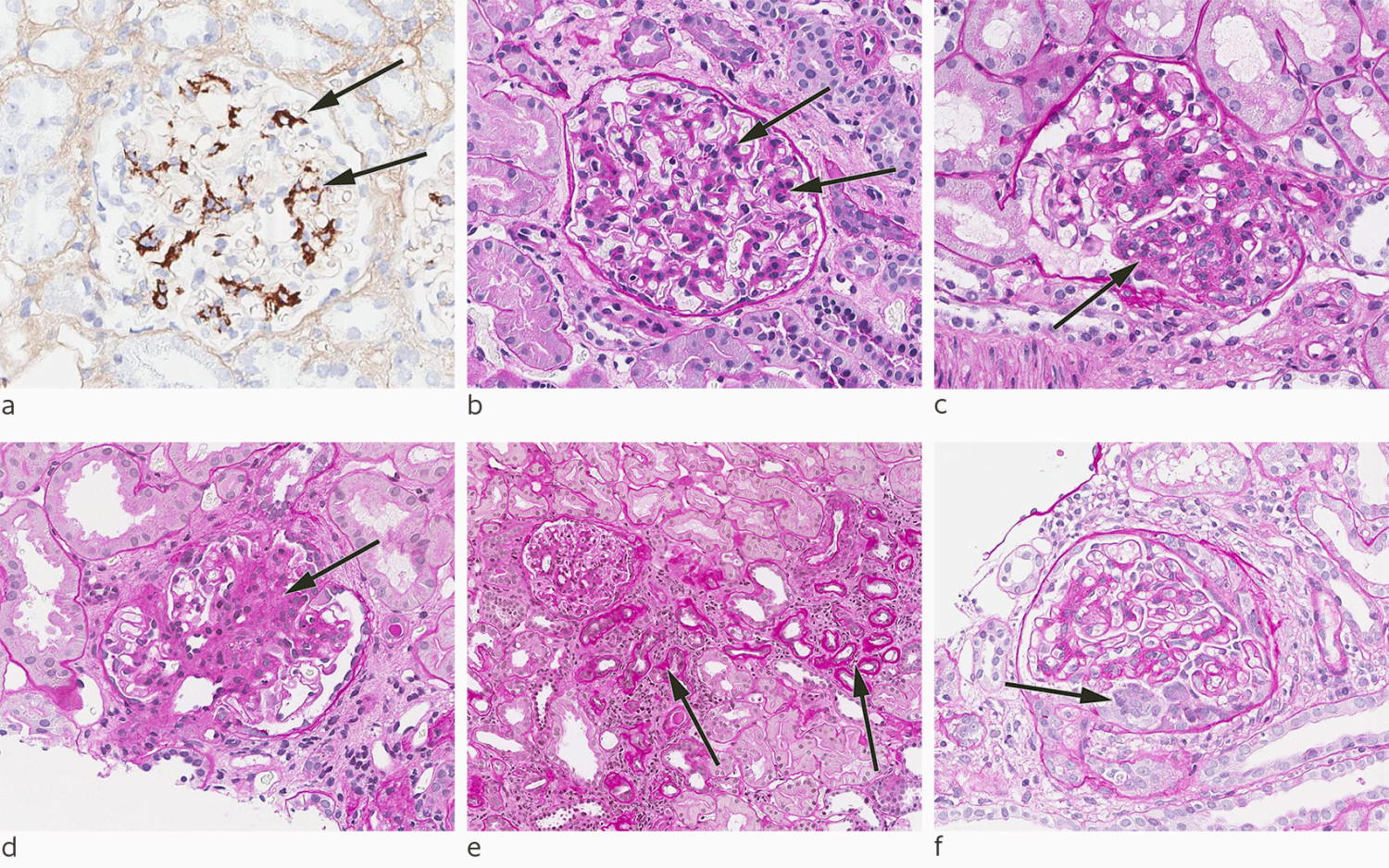 Figur 1 a) Mesangialt IgA-nedslag p&aring;vist ved immunhistokjemisk metode. b) Mesangial hypercellularitet (M-en i MEST-C&hellip;