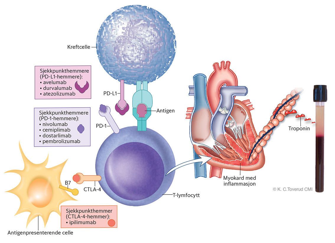 Figur 1 Patofysiologien ved sjekkpunkthemmerindusert myokarditt. Sjekkpunkthemmere binder seg til proteiner p&aring; T-cellene (PD&hellip;