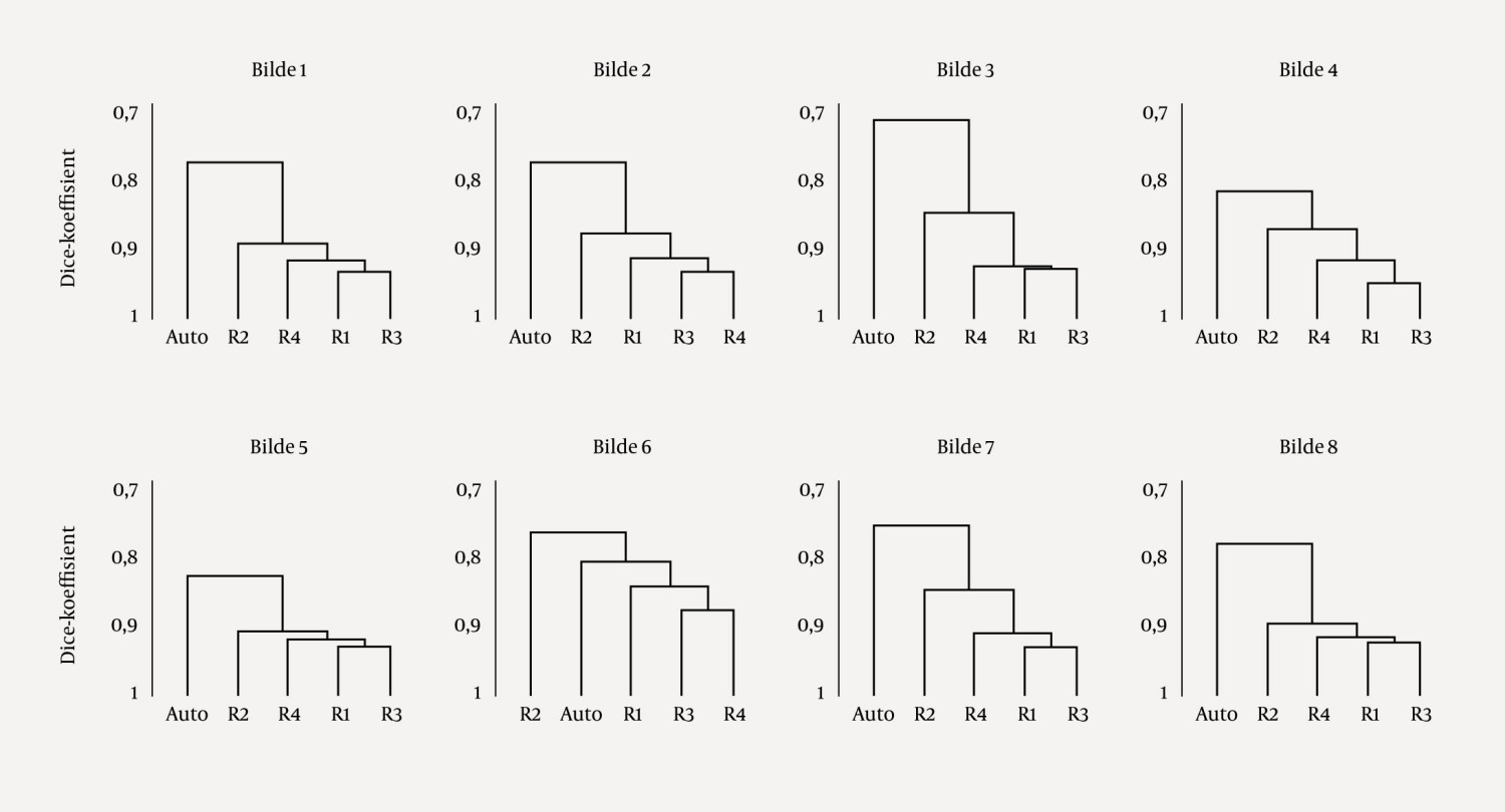 Figur 1 Dendrogrammer fra agglomerativ hierarkisk klyngeanalyse basert p&aring; data fra R&oslash;islien og Samset (1). Fire radiologer &hellip;