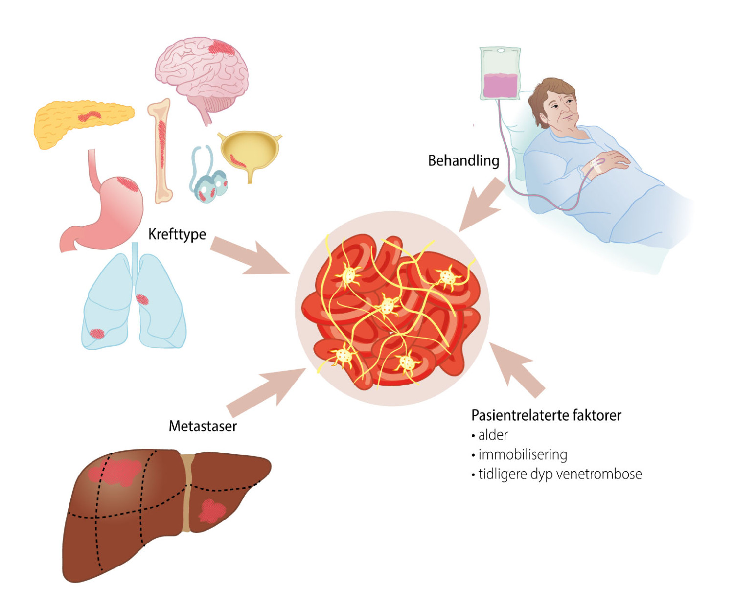 Figur 1 Risikofaktorer for ven&oslash;s tromboembolisme ved kreft.