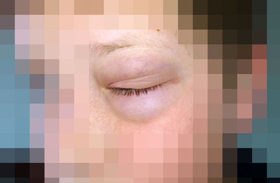 Figur 3 Illustrasjonsfoto: Hevelse og svak r&oslash;dme omkring venstre &oslash;ye og kinn hos en annen pasient med infestasjon av&hellip;