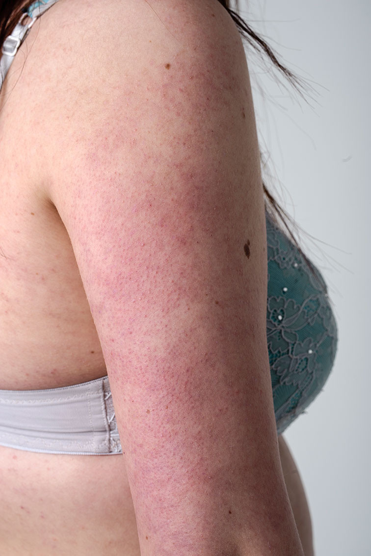 Figur 1 Keratosis pilaris p&aring; overarmen.