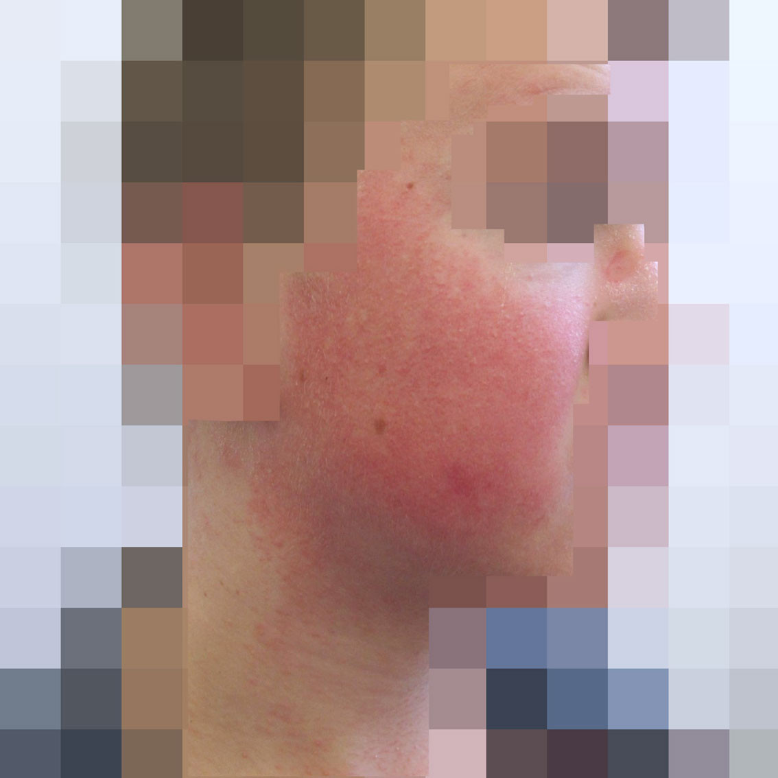 Figur 2 Keratosis pilaris rubra hos pasient med Juberg-Marsidis syndrom, et X-bundet genetisk syndrom med&hellip;