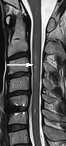 Figure 1 Sagittal T2-weighted MR image of the spinal column shows a pathological intramedullary signal at levels C2&ndash;C4 &hellip;