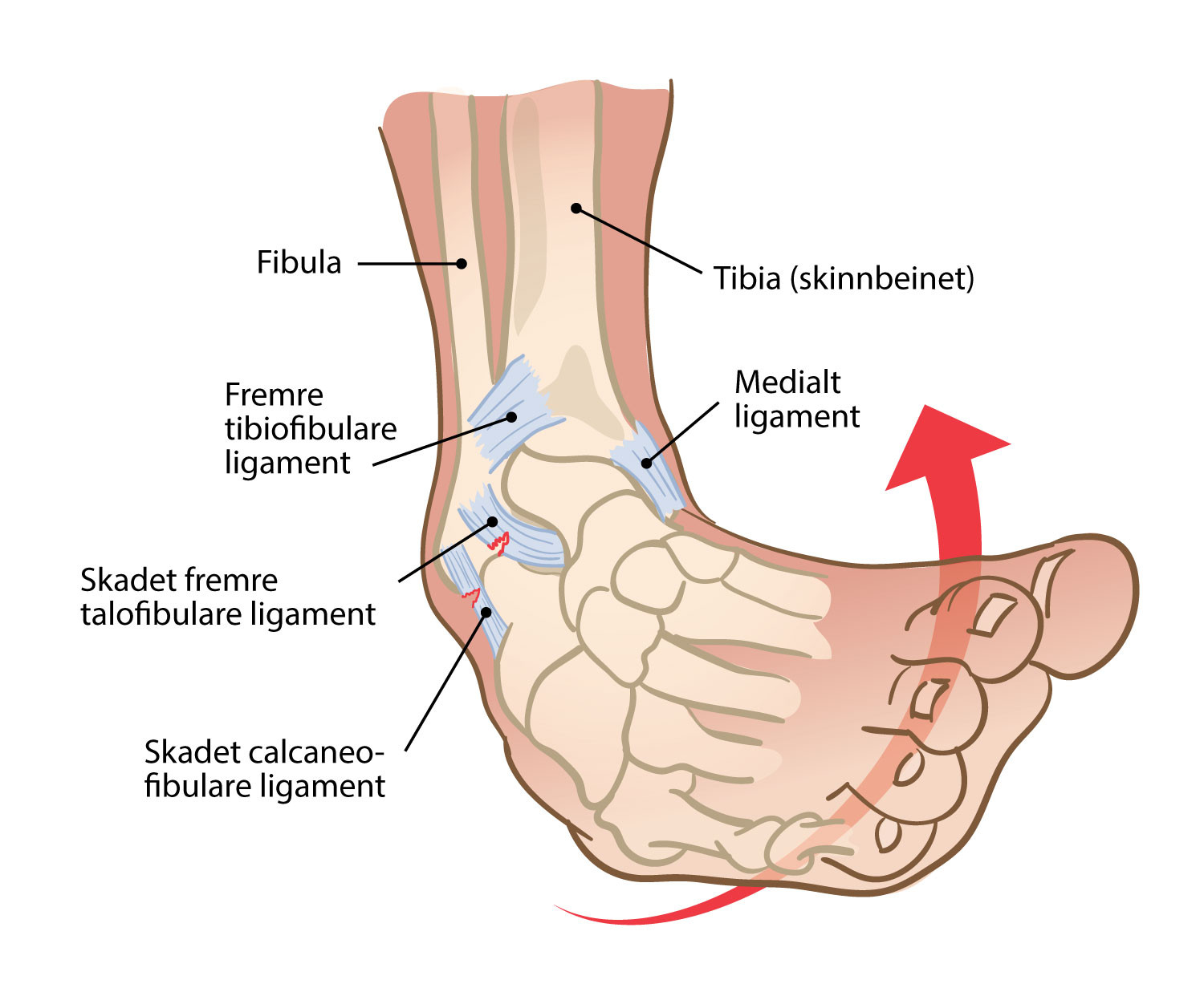 Figur 1 Lateral ankelligamentskade. Det fremre talofibulare ligamentet er det som oftest skades ved akutte laterale&hellip;
