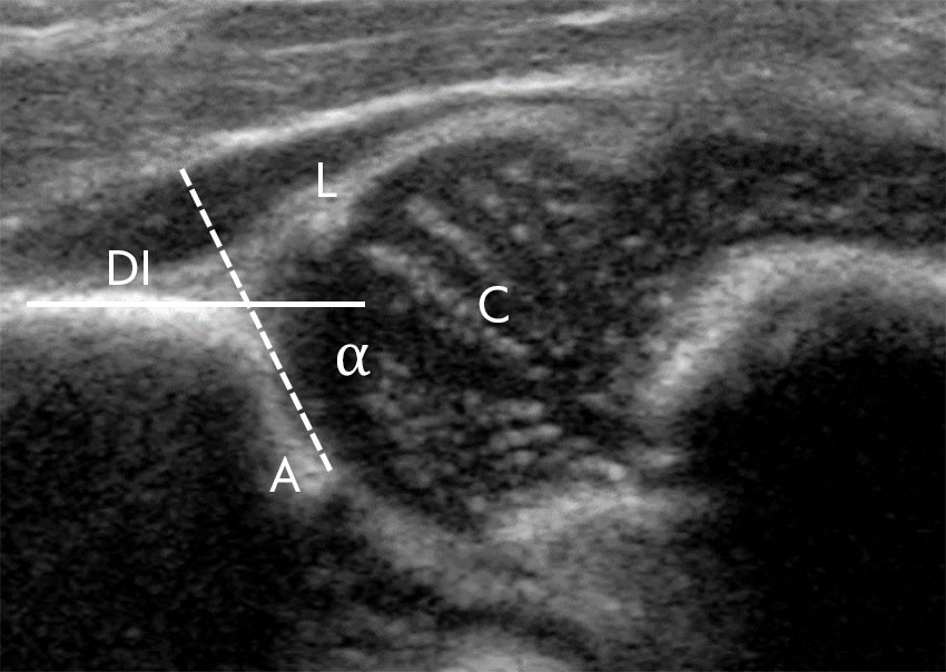Figur 1 Ultralydunders&oslash;kelse med koronalt standardsnitt gjennom et normalt hofteledd hos en nyf&oslash;dt jente. Bildet viser caput&hellip;