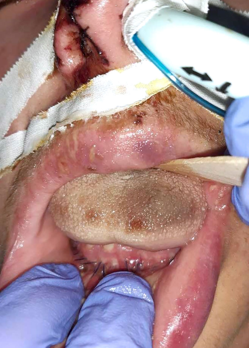 Figur 2 Tunge dag 1 postoperativt, med iskemi og nekrotiske omr&aring;der p&aring; tungespissen.