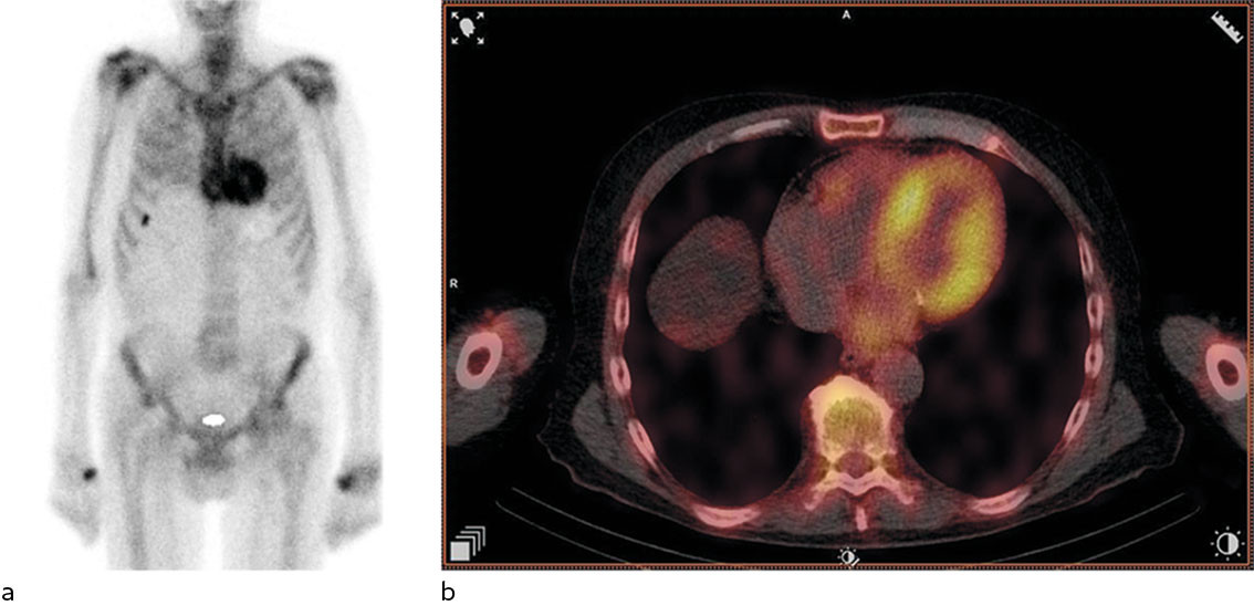 Figure 2 99&nbsp;mTc-DPD scintigraphy. Planar image (a) and SPECT-CT (b) reveal a strong positive signal in the myocardium. This&hellip;