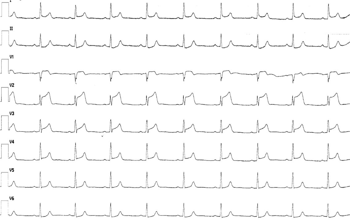 Figur 1 Elektrokardiogram (EKG) ved brystsmerter.