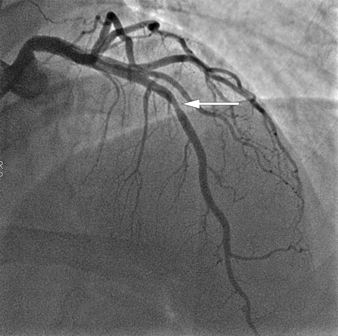 Figur 3 Mulig LAD-stenose p&aring; koronar angiografi.
