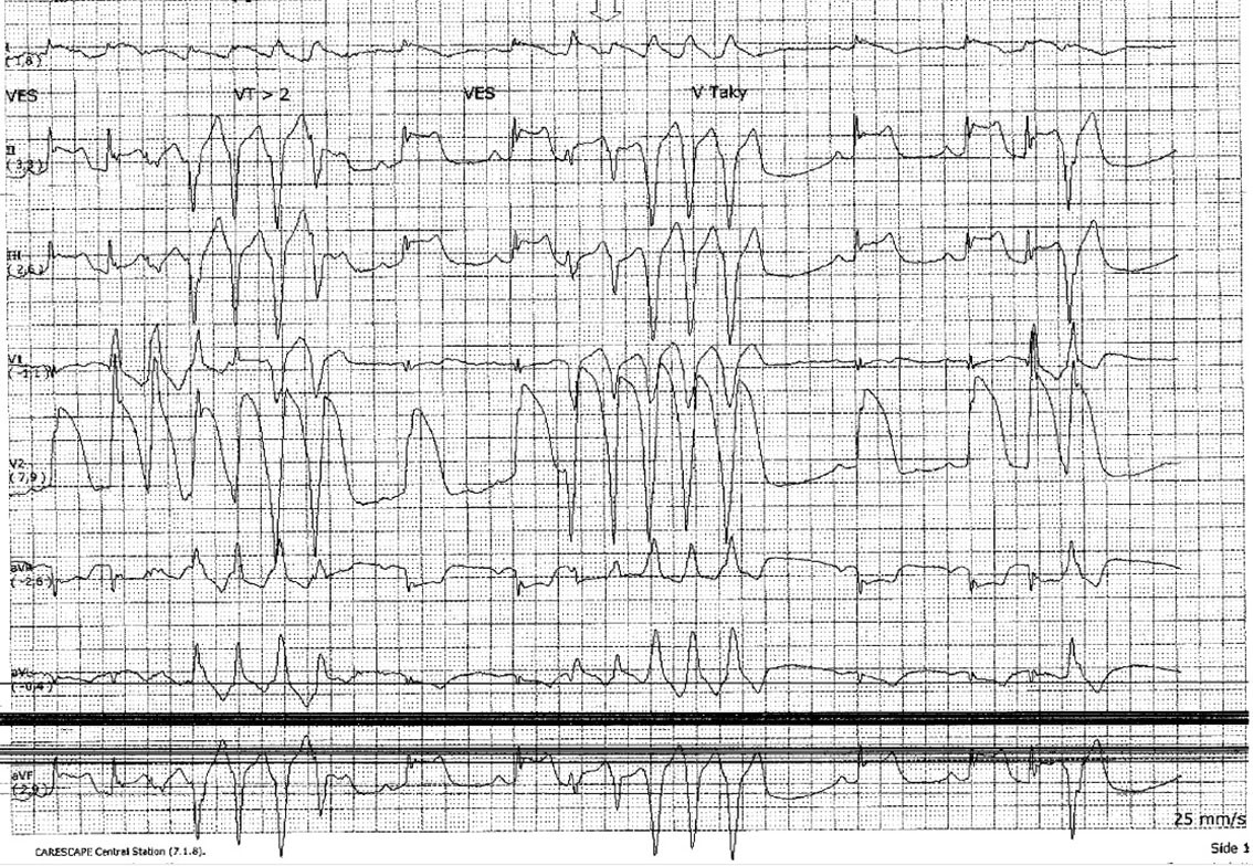 Figur 4 Telemetriutskrift ved brystsmerter som viser ST-elevasjon og ikke-vedvarende ventrikkeltakykardi.