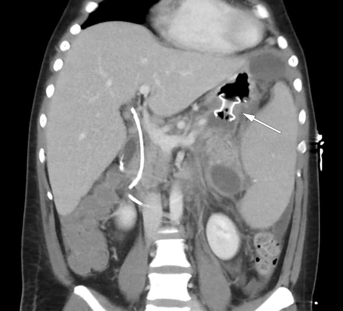 Figure 3 CT abdomen showing a Hot AXIOS lumen-apposing metal stent (LAMS) (arrow), effective drainage and decreasing&hellip;