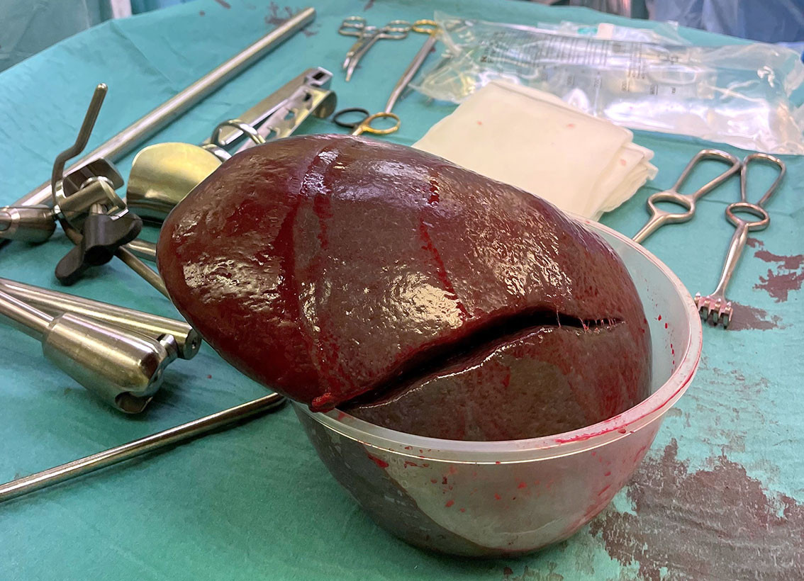 Figur 4 Miltpreparatet med vekt 1&nbsp;609&nbsp;g (normalt 120&ndash;200&nbsp;g) og st&oslash;rrelse 23 &times; 18 &times; 8&nbsp;cm (normalt < 12&nbsp;cm i lengde).