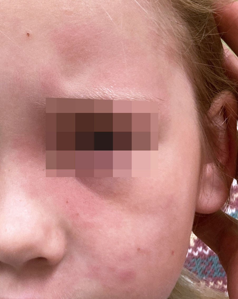 Figur 1 Eit diskr&eacute; og diffust avgrensa makul&aelig;rt erytem kring venstre auge som tilkom eit par dagar f&oslash;r innlegging.