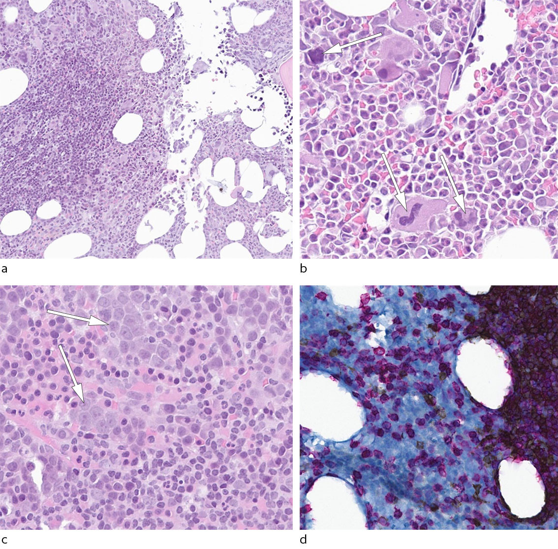 Figur 2 a) Beinmargen er hypercellul&aelig;r og det er flere reaktive lymfoide infiltrat til stede (ett infiltrat i venstre&hellip;