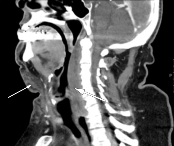 Figur 1 CT collum med intraven&oslash;s kontrast i sagittalplan viste langstrakt retrofaryngealt hematom med opptil 18&nbsp;mm tykkelse &hellip;
