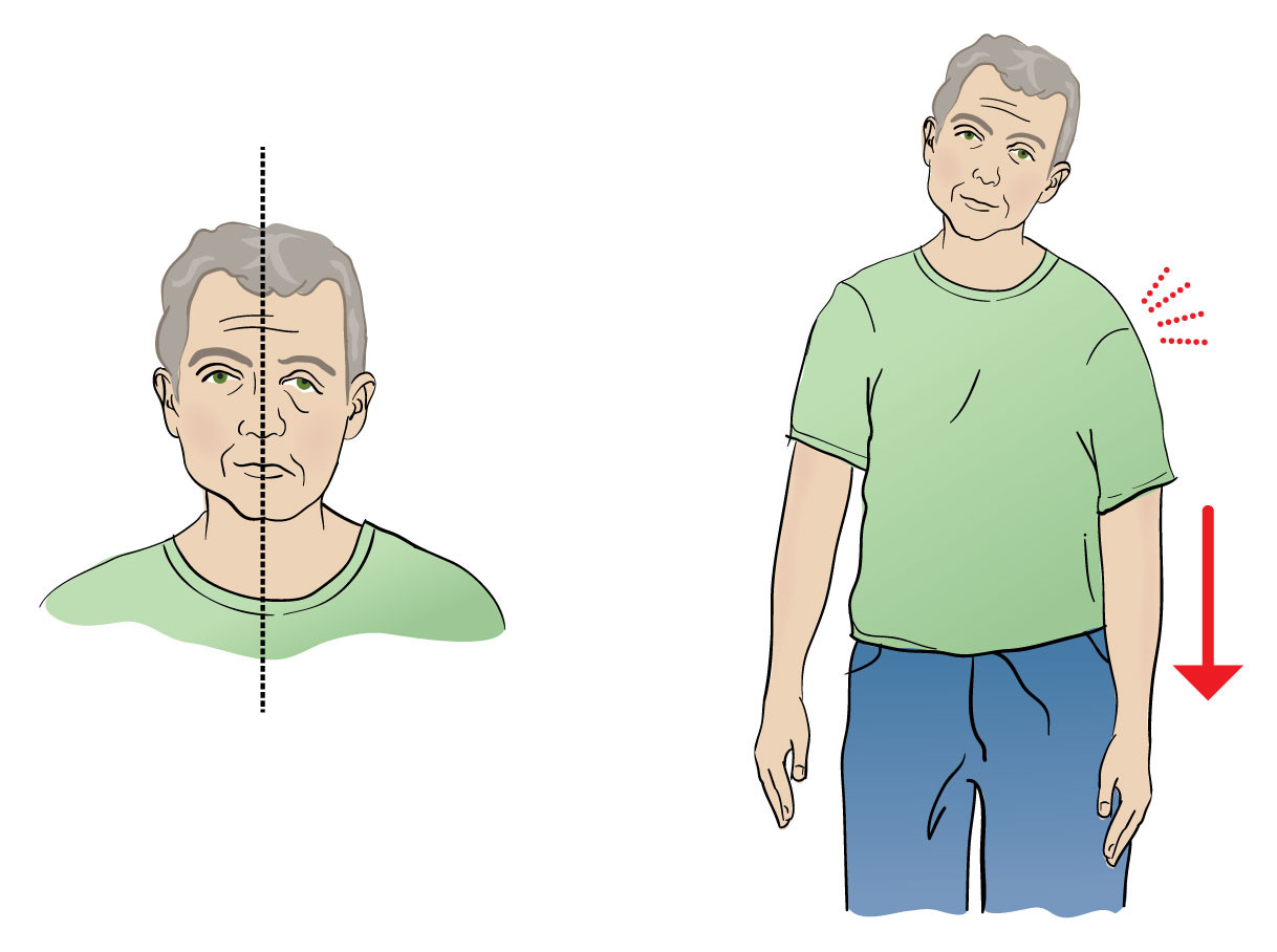 Figur 2&nbsp;Typisk for transitorisk iskemisk attakk (TIA). Akutte negative nevrologiske symptomer og tegn av kort varighet og&hellip;