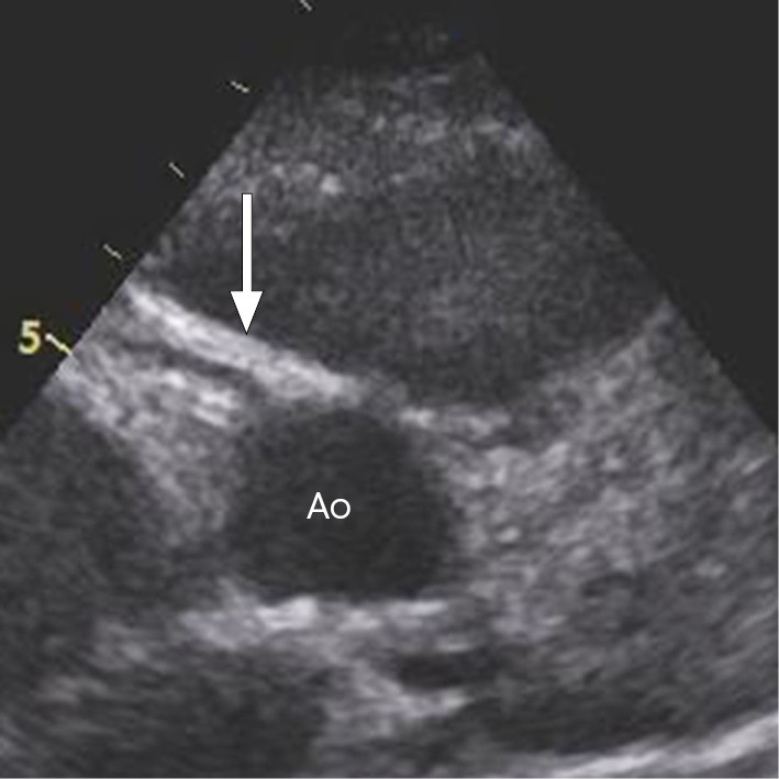 Figur 1 Ekkokardiografisk fremstilling av aorta i tverrsnitt (Ao) med avgang av h&oslash;yre koronarkar (pil). H&oslash;yre koronarkar har&hellip;