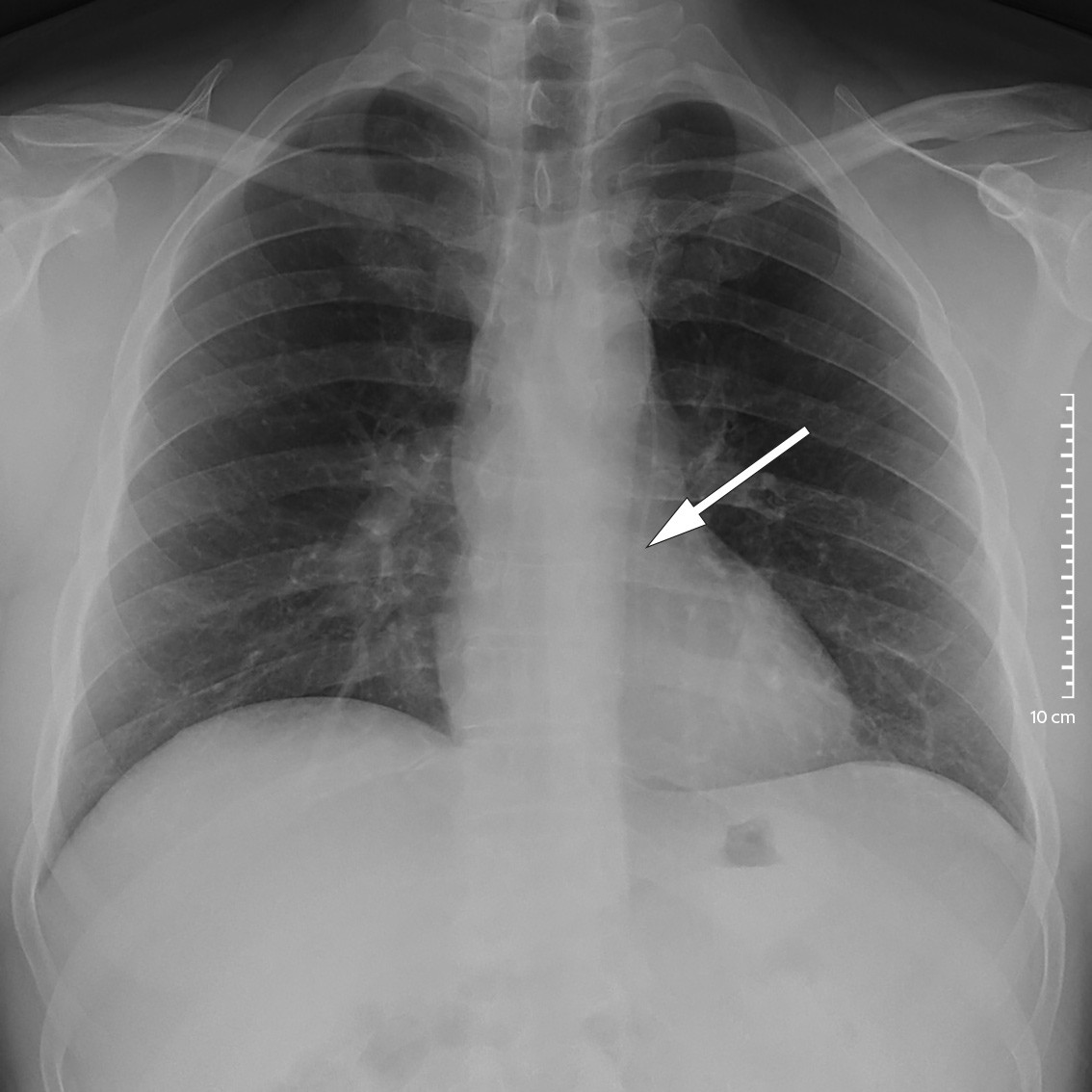 Figur 2 R&oslash;ntgen toraks viser sentralven&oslash;st kateter gjennom venstre vena subclavia. Kateteret har videre et unormalt leie p&aring;&hellip;