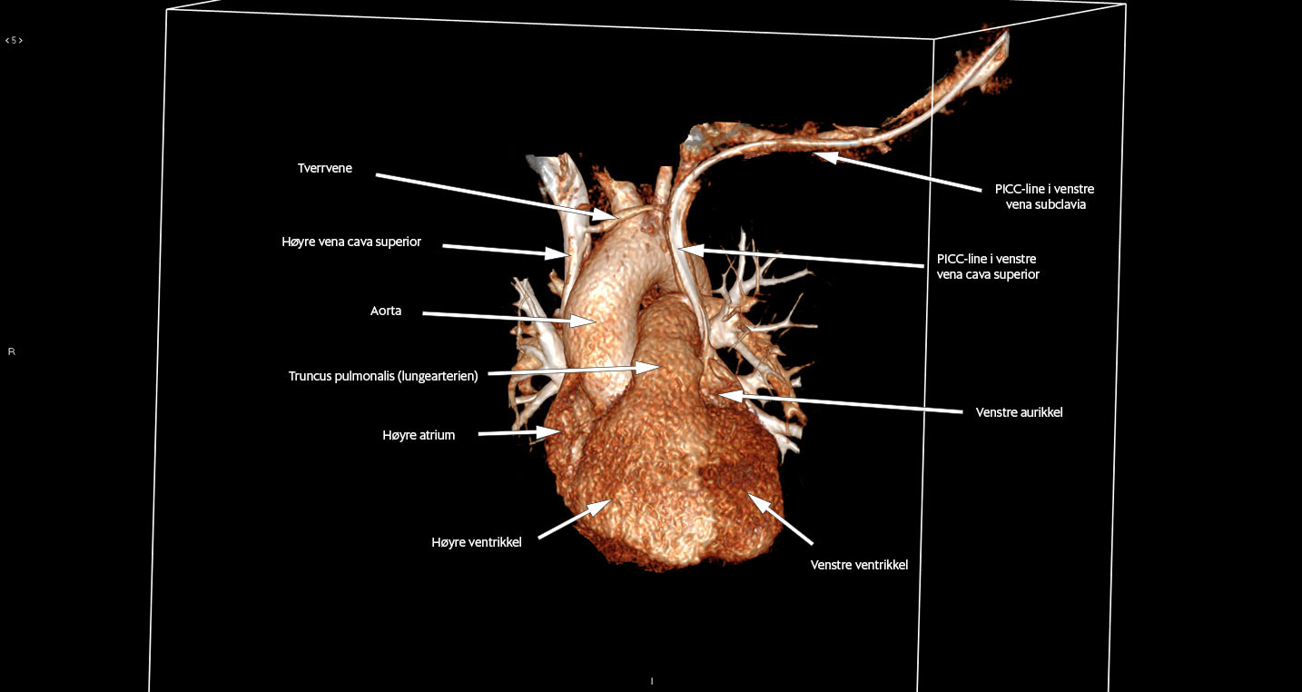 Figur 3b CT toraks, 3D-rekonstruksjon. Man ser tverrvene og sentralven&oslash;st kateter i persisterende venstre vena cava superior.