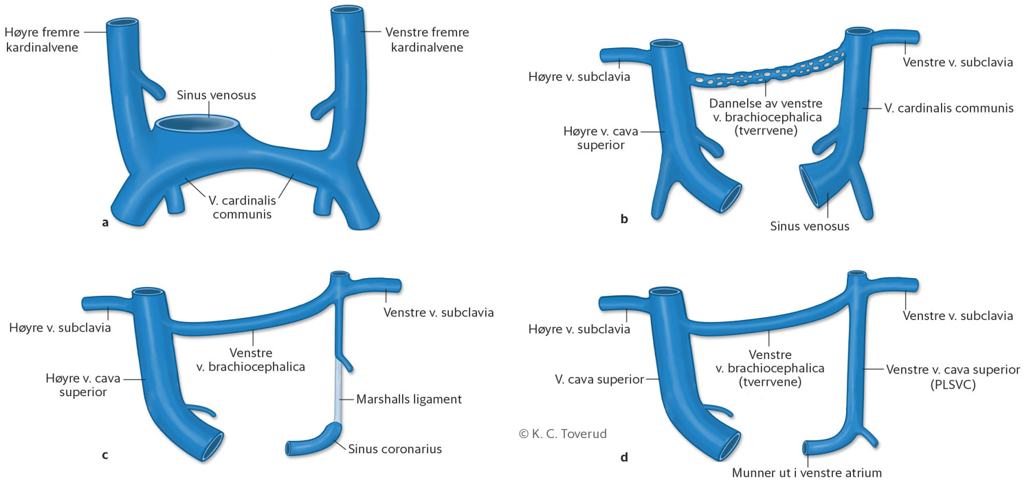 Figur 4 Normal embryologisk utvikling av venesystemet ved uke 5 (a), uke 7 (b) og uke 8 (c). Pasientens anomali er vist i&hellip;