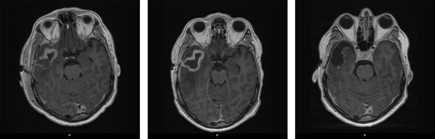 Figur 6 MR-caput med aksial T1-vekting med kontrast etter f&oslash;rste kirurgi, ved progrediering og etter andre kirurgiske&hellip;