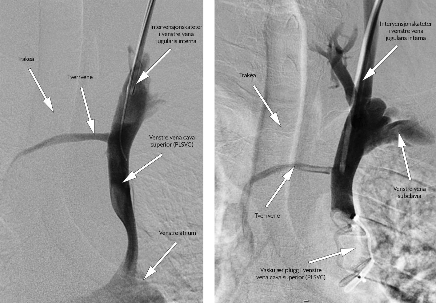 Figur 7 Venografi ved endelig lukking av persisterende venstre vena cava superior. Til venstre: f&oslash;r behandling. Til h&oslash;yre:&hellip;