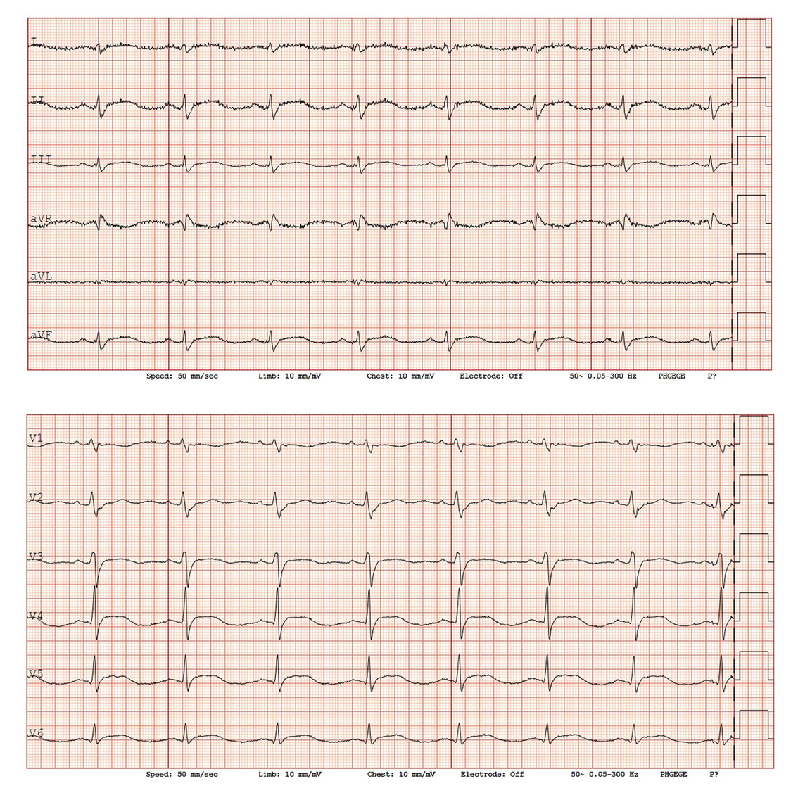 Figure 1 First ECG on the second day of hospitalisation showed mild ST elevation in leads II, III and aVF, as well as V3&ndash;V6.