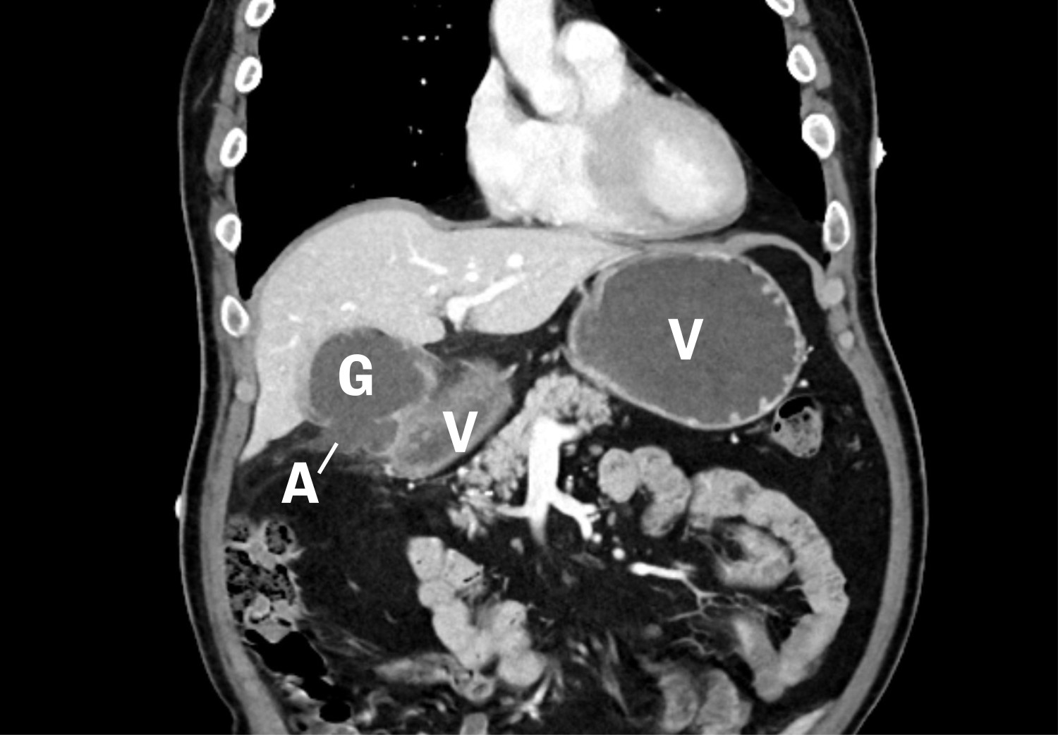 Figur 1 CT abdomen dag to viser ventrikkel (V), gallebl&aelig;re (G) og abscess (A).