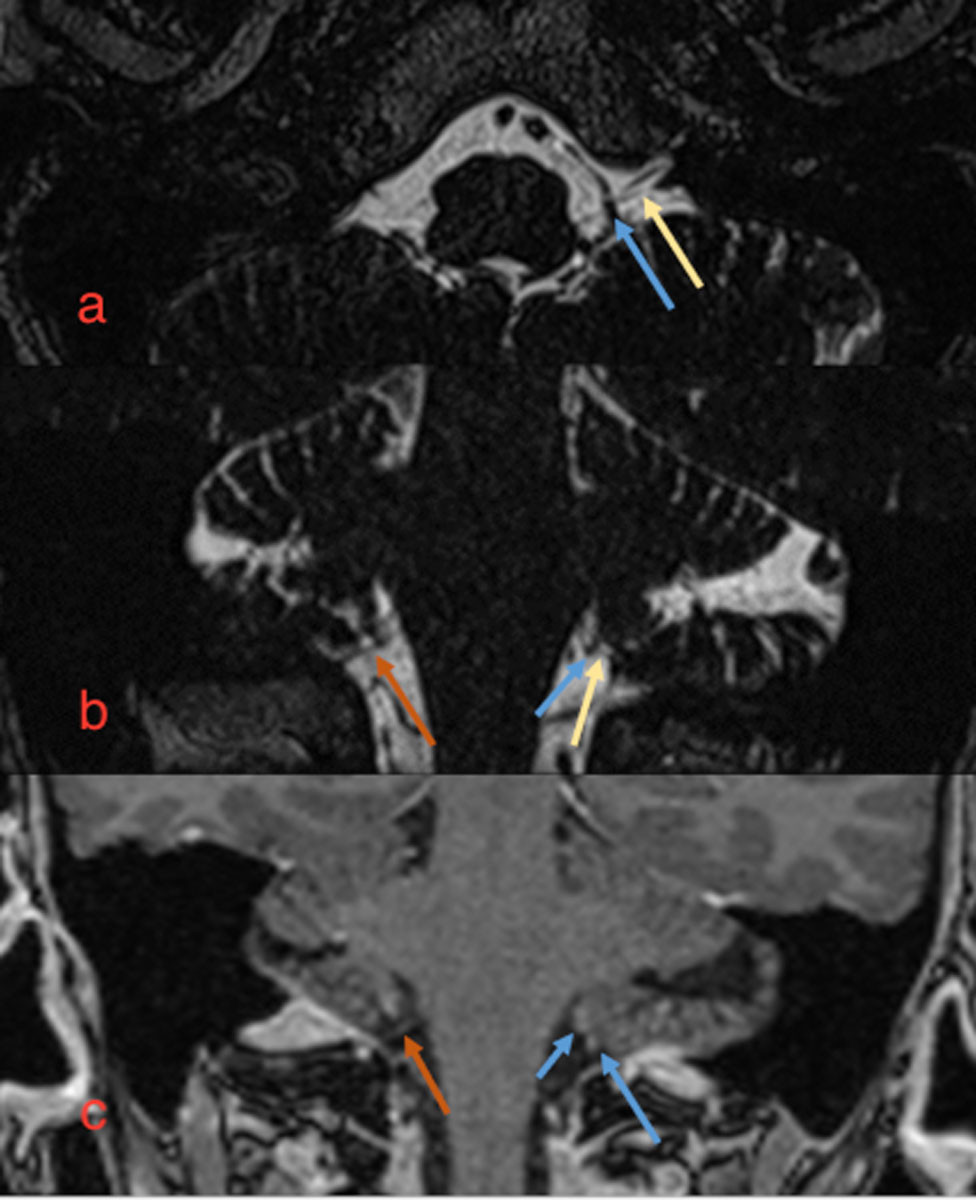 Figure 1 MR skull base, a) axial and b) coronal: T2 TSE sequence showed a normal course of the glossopharyngeal nerve on the&hellip;