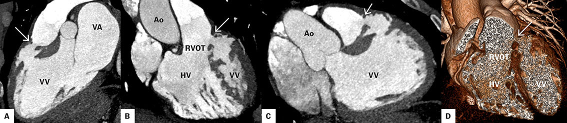 Figur 3 Computertomografi med kontrastv&aelig;ske av hjerte i sagittalplan (A), koronalplan (B), transversalplan (C) og 3D&hellip;