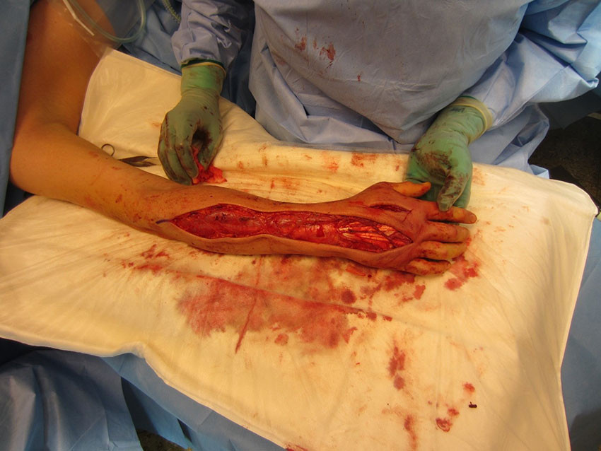 Figur 2b Peroperativt bilde av samme pasient etter kirurgisk fjerning av infisert og avaskul&aelig;rt vev opptil flere centimeter&hellip;