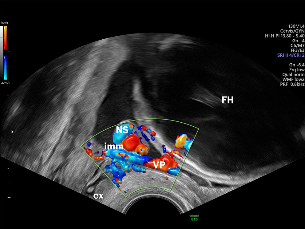 Figur 1 Vasa previa. Ultralydbilde og video fra unders&oslash;kelse med transvaginal ultralyd viser cervix, nedre placentakant,&hellip;