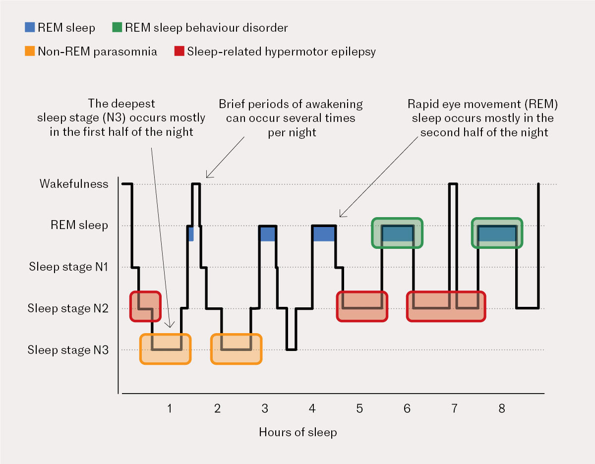 Figure 1 Hypnogram showing sleep stages over time and typical behaviour for different nocturnal seizure episodes (6, 10, 12,&hellip;