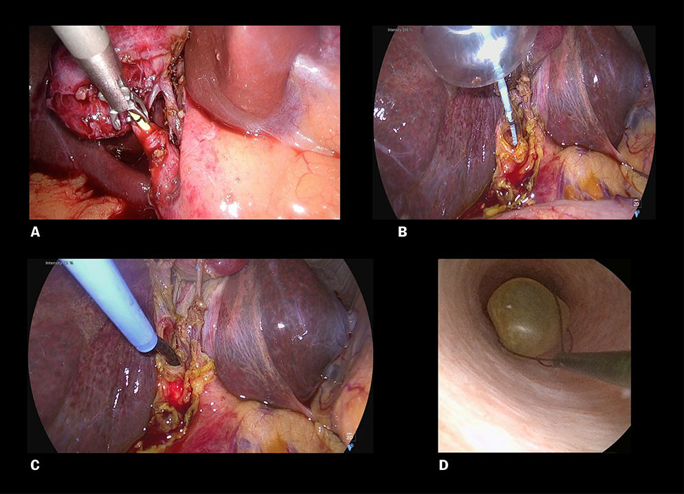 Figur 1 Introduksjon av kolangiografikateter i gallebl&aelig;regangen (a), ballongdilatasjon av gallebl&aelig;regangen (b), introduksjon&hellip;