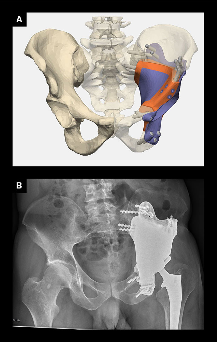 Figur 3 a) Computerassistert 3D-rekonstruksjon etter fjerning av bensarkom i acetabulum. 3D-printet titanprotese med&hellip;