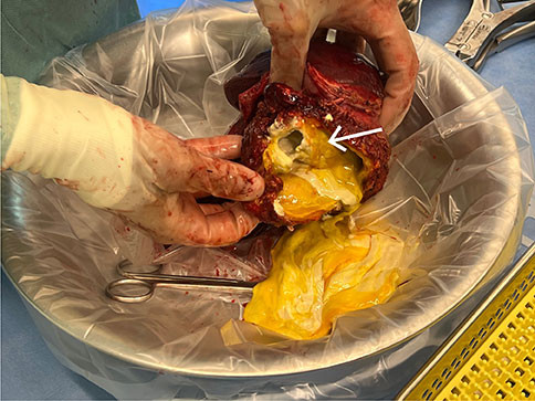 Figur 2 Figuren viser et operasjonspreparat best&aring;ende av en del av lever og p&aring;hengende h&oslash;yre lunges under- og midtlapp&hellip;