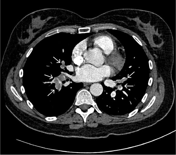 Figure 1 Axial section of CT pulmonary angiography showing contrast defects (arrows) in segmental pulmonary arteries&hellip;