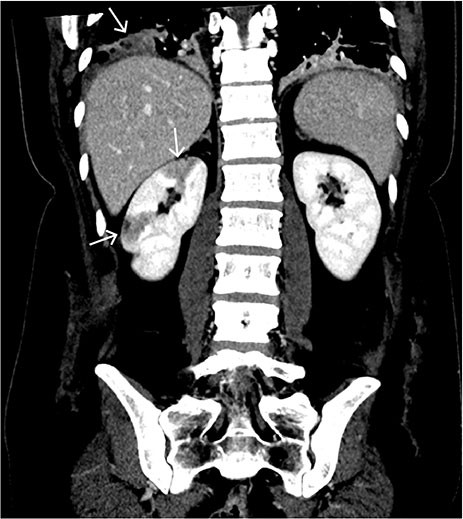 Figure 2 Coronal section in abdominal CT with intravenous contrast showing well-demarcated, peripheral, wedge-shaped&hellip;