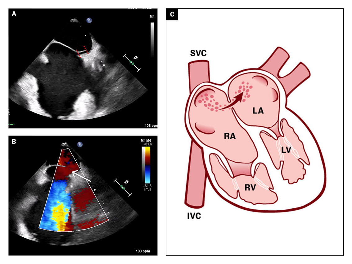 Figure 3 2D transoesophageal echocardiogram shows patent foramen ovale (a, see stripes) with spontaneous right-to-left shunt&hellip;