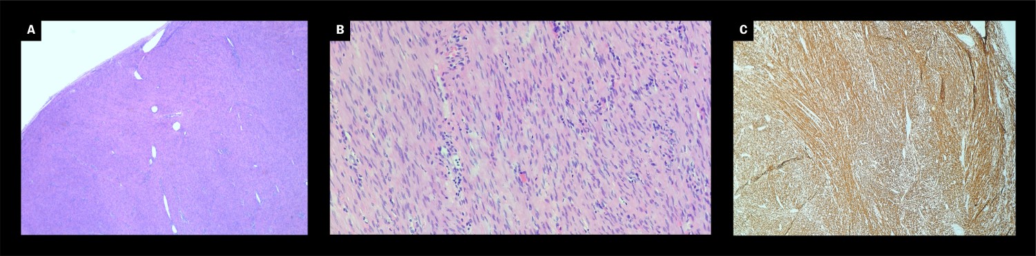 Figur 2 Mikroskopisk ses fasikler av spolformede celler med eosinofilt cytoplasma. a) hematoksylin-eosin, forst&oslash;rrelse &times;20)&hellip;