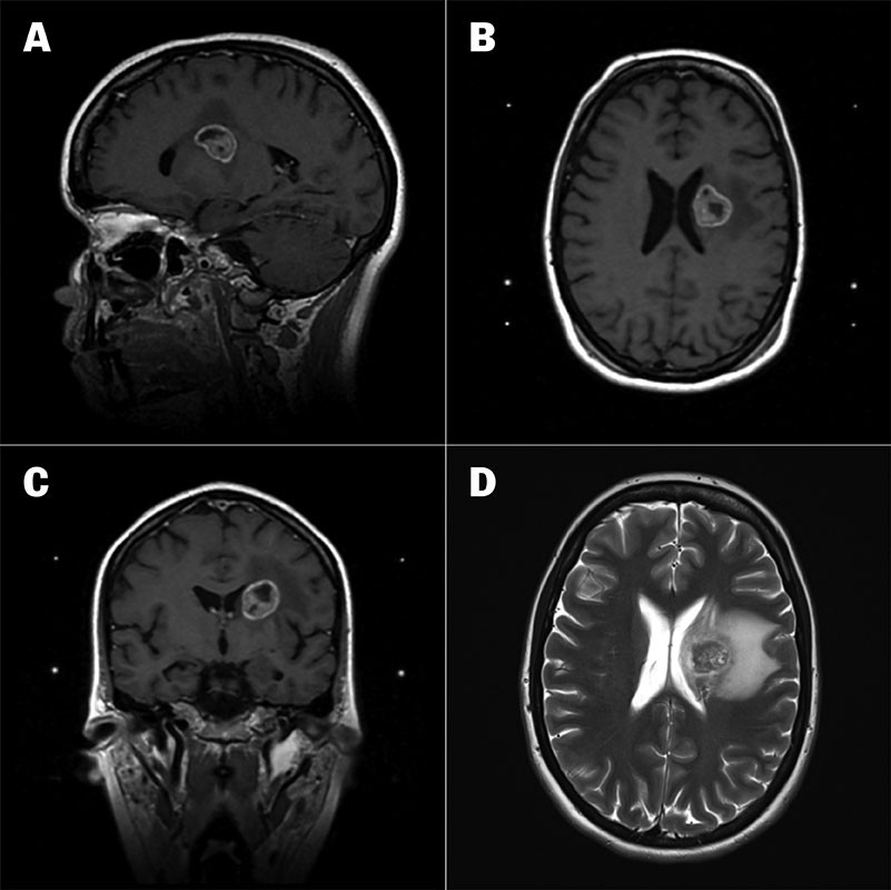 Figur 1 a) Sagittal MR caput med kontrast p&aring; tidspunkt for str&aring;leknivbehandling. b) Aksial MR caput med kontrast p&aring;&hellip;