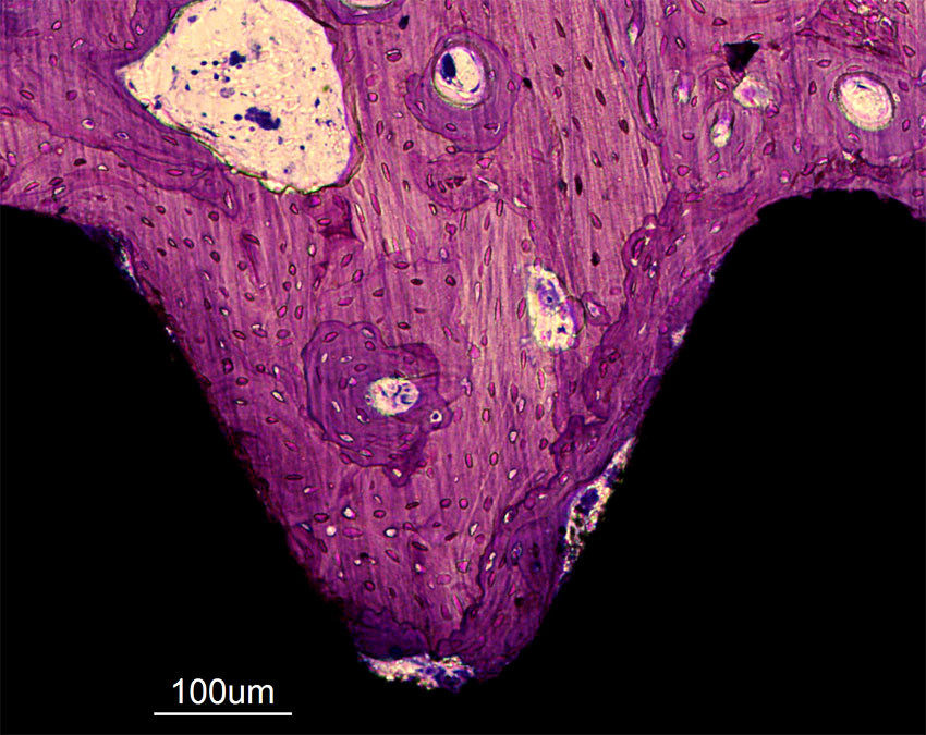 Figure 1 Osseointegrated titanium screw. Bone tissue is coloured in purple, and the implant in black. Direct contact between&hellip;