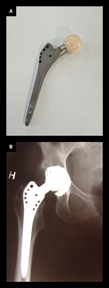 Figure 2 a) Titanium femoral component (Zweym&uuml;ller) with a ceramic head (Al2O3) used in Norway between 1985 and 1988. b) X&hellip;